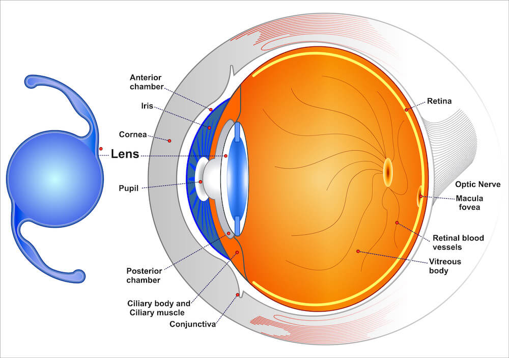 Diagram of how and IOL works in the eye