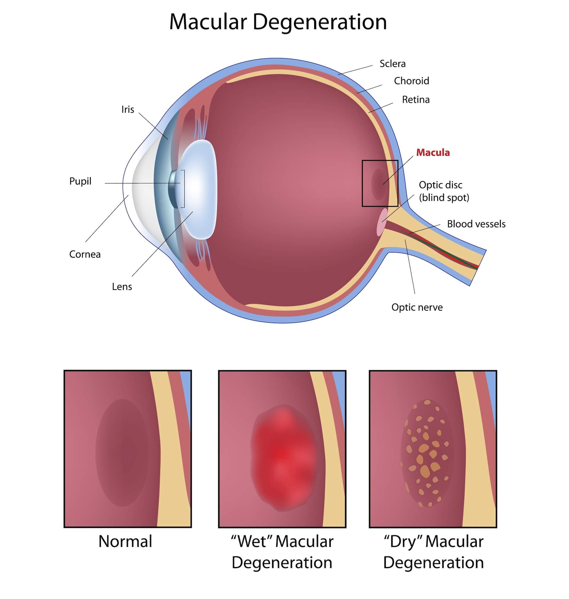 Diagram showing the effects of macular degeneration