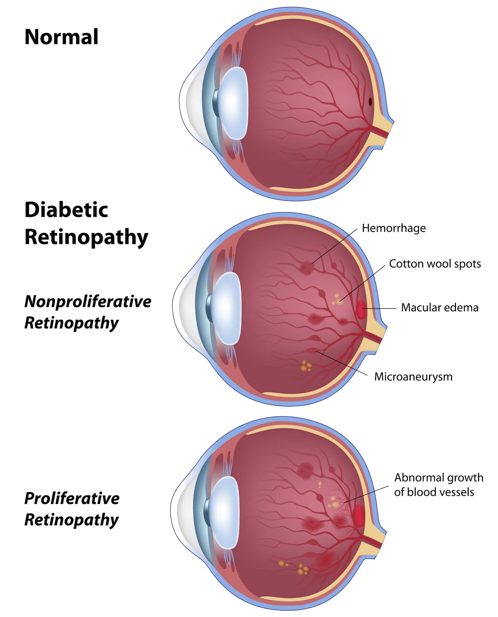 Diagram showing effects of diabetic retinopathy