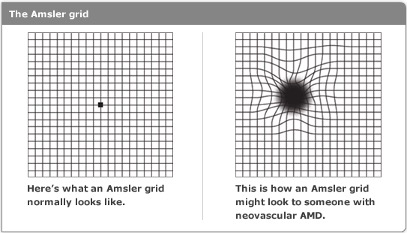 Amsler grid with and without macular degeneration